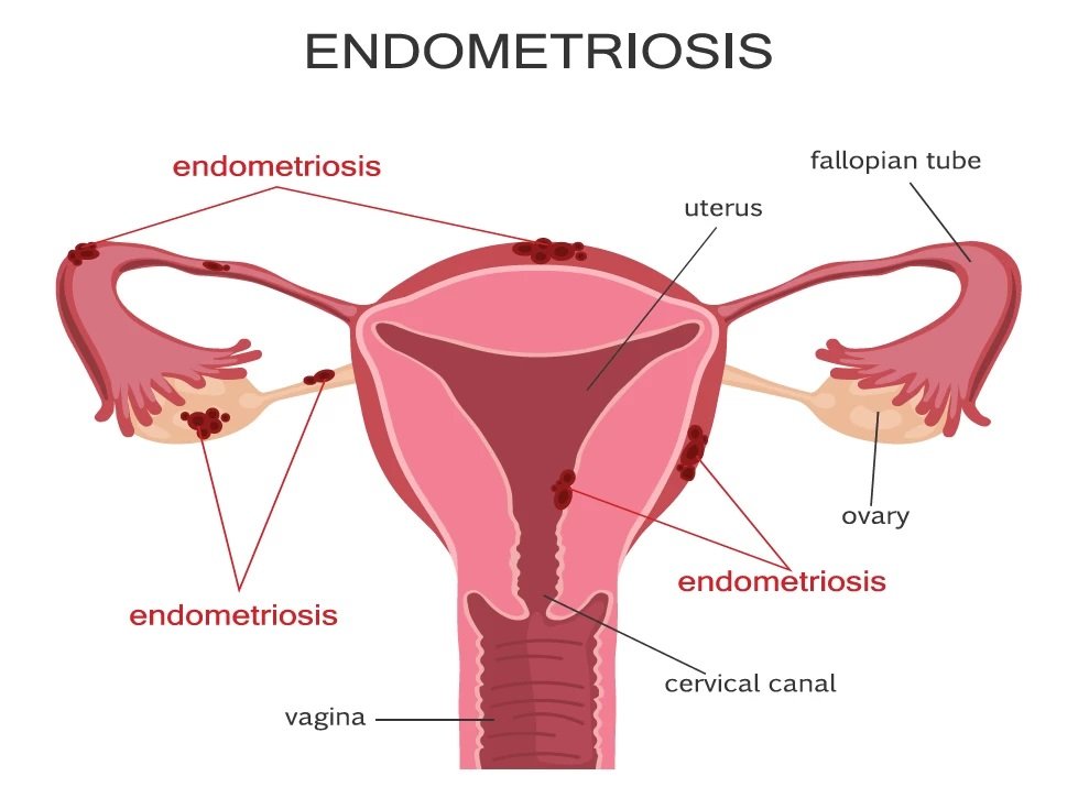 How Does Endometriosis Impact Fertility?