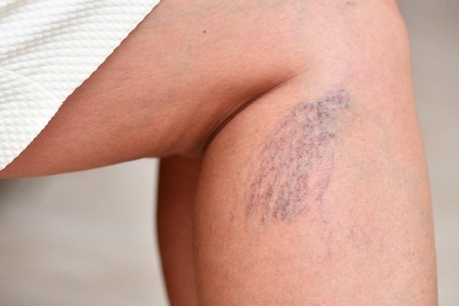 How Spider Veins Can Affect Women’s Cardiovascular Health  